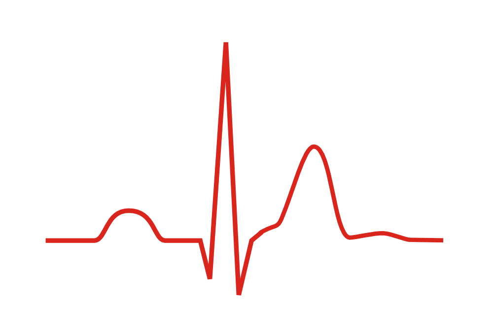An ECG wave showing a shortened QT interval